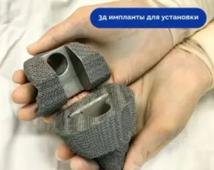 В Сургуте врачи восстановили коленный сустав с помощью 3D-имплантов